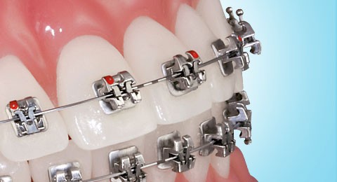 the orthodontic-restorative connection