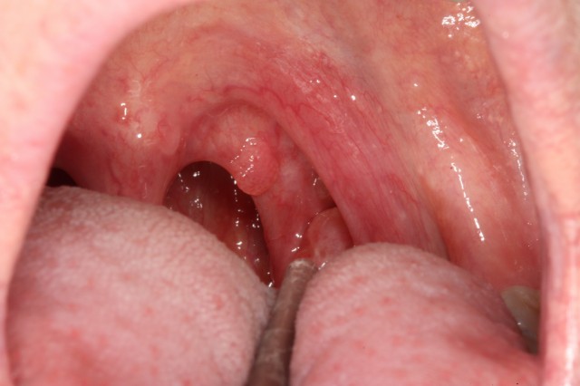 Enterobius vermicularis gpc. Tratament helmintiaza, Helmintiaza, Helmintiaza doi viermi