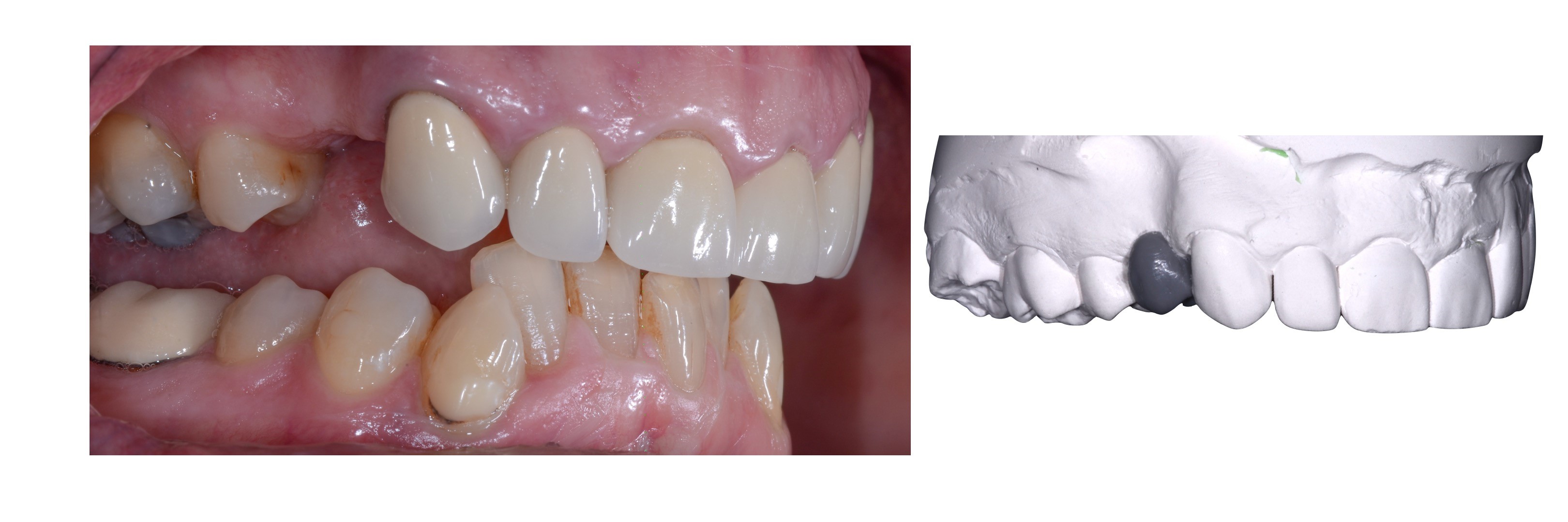 dental implants figure 003