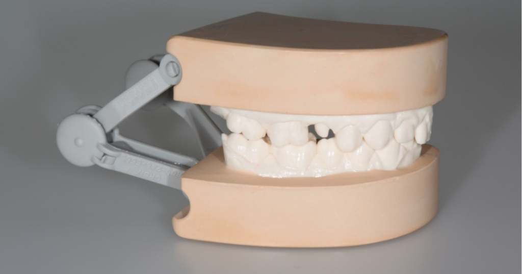 Triple tray impression cast mounted on a hinge articulator for evaluating a posterior single-unit restoration.