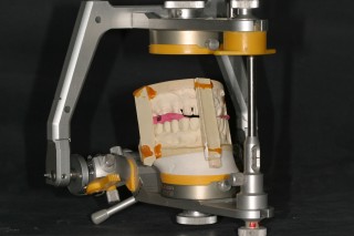 Steps in Cross-Mounting a Case Mounting the mandibular preparations to the maxillary provisional cast 320x213 1