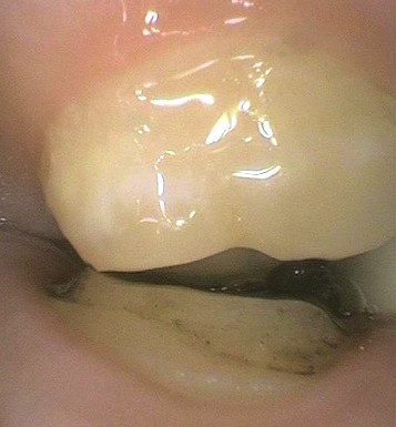 The Mystery of Tooth Preparation Carson 012113 Feat