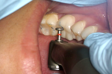 Making Occlusal Adjustments Easier DG080613 Carson Fig 1