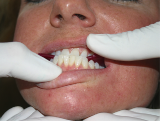 How To Take a Protrusive Bite Record Protrusive2 317x240 1