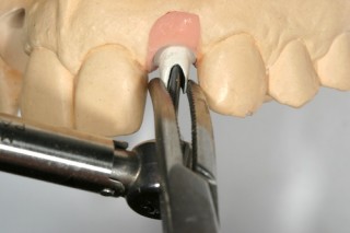 When You Torque the Implant Abutment Screw Torquing Abutments 320x213 1