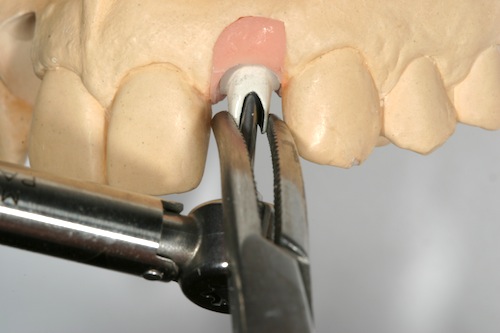 When You Torque the Implant Abutment Screw Torquing Abutments