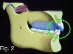 Occlusal Appliances: The Options Frank Spear Occlusal Appliances Figure 2