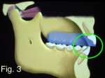 Occlusal Appliances: The Options Frank Spear Occlusal Appliances Figure 3