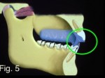 Occlusal Appliances: The Options Frank Spear Occlusal Appliances Figure 5
