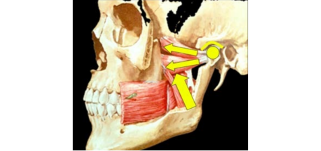 4 Essential Leaf Gauge Dental Techniques Explained Anatomical illustration of the lateral pterygoid muscle with arrows showing its pull on the mandible, the muscle targeted during leaf gauge dental deprogramming.