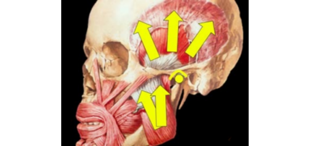 4 Essential Leaf Gauge Dental Techniques Explained Anatomical illustration of the temporalis and masseter muscles with arrows showing their upward pull, illustrating condylar seating during a leaf gauge dental exam.