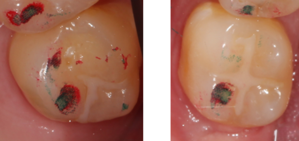 4 Essential Leaf Gauge Dental Techniques Explained Side-by-side occlusal photos of a molar with red and green articulating paper marks showing contact points identified during a leaf gauge dental exam.