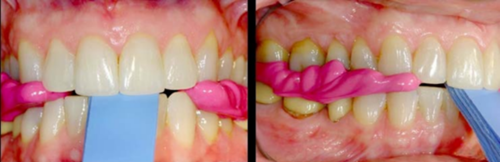 4 Essential Leaf Gauge Dental Techniques Explained Front intraoral view of a blue leaf gauge dental tool with pink bite registration material placed between the upper and lower anterior teeth.