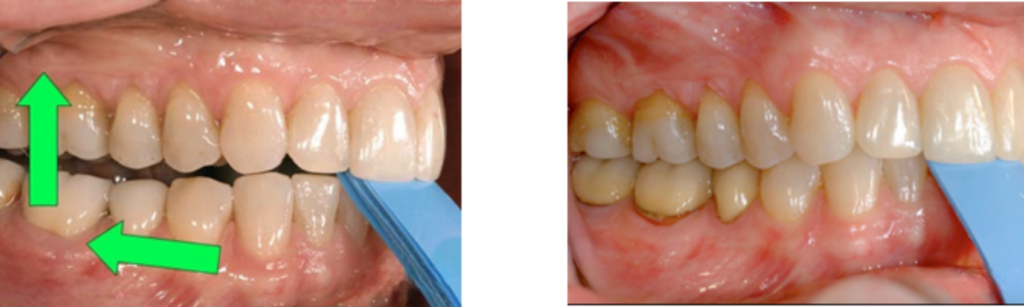 4 Essential Leaf Gauge Dental Techniques Explained Right lateral intraoral view of a leaf gauge dental tool between the posterior teeth, with green arrows showing an upward and backward direction in the left panel; the right panel shows the same view with the tool positioned further between the teeth and no arrows.