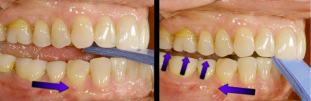 4 Essential Leaf Gauge Dental Techniques Explained Right lateral intraoral view of a leaf gauge dental tool between the posterior teeth, with a purple arrow pointing backward in the left panel, and three purple arrows pointing upward between the teeth alongside a backward-pointing arrow in the right panel.