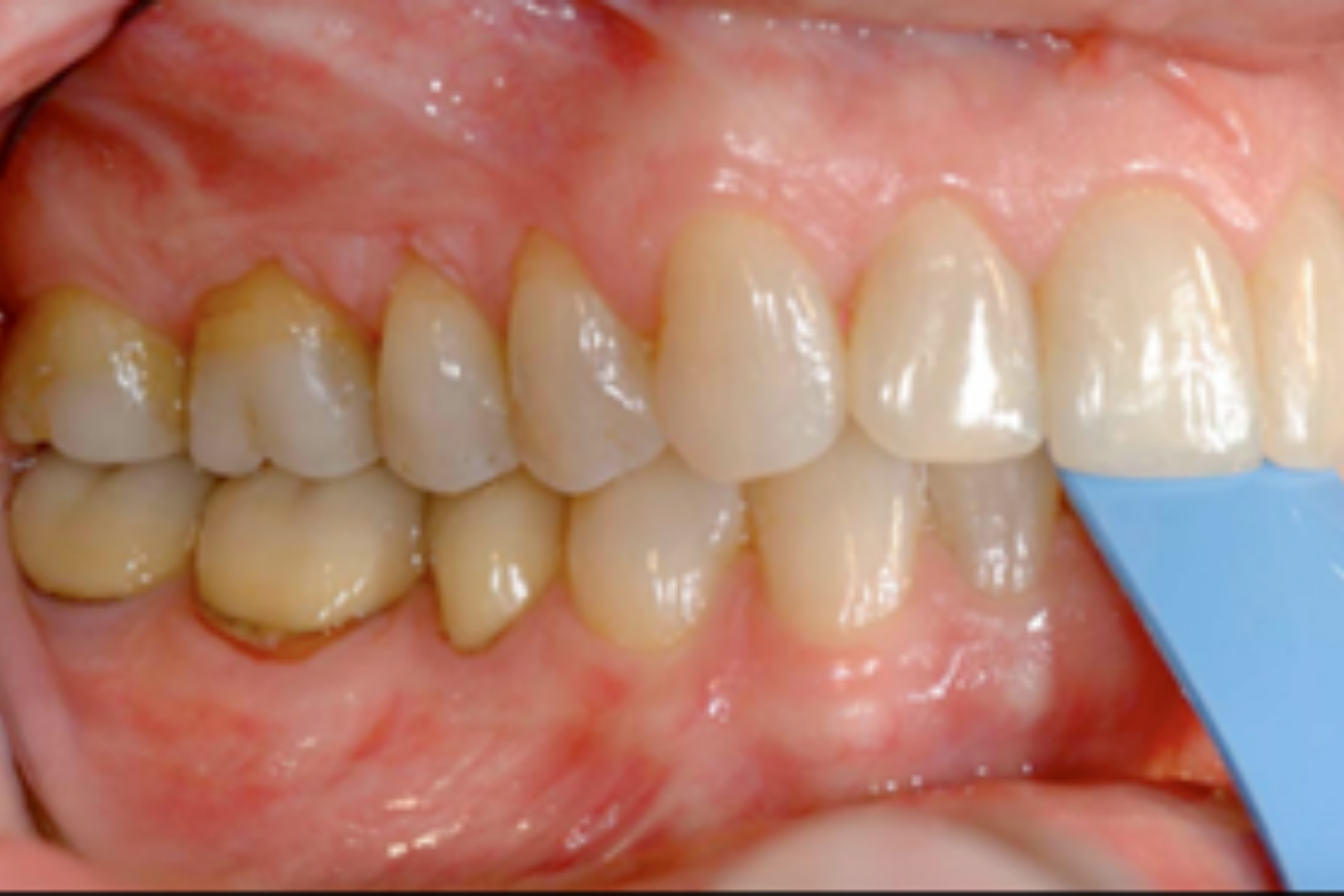4 Essential Leaf Gauge Dental Techniques Explained Blue leaf gauge dental tool positioned between the upper and lower posterior teeth during a clinical exam.