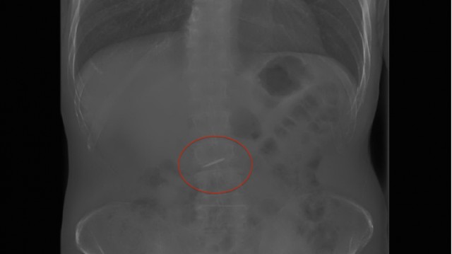 Accidental Ingestion of Dental Materials: Treatment and Prevention Darin Dichter Accidental Ingestion of Dental Materials Featured Image