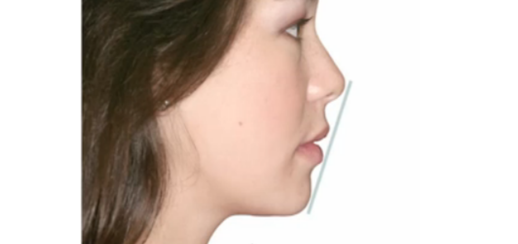 efrver Profile facial evaluation using the esthetic plane to assess upper and lower lip position relative to the nose and chin during facial esthetic analysis.