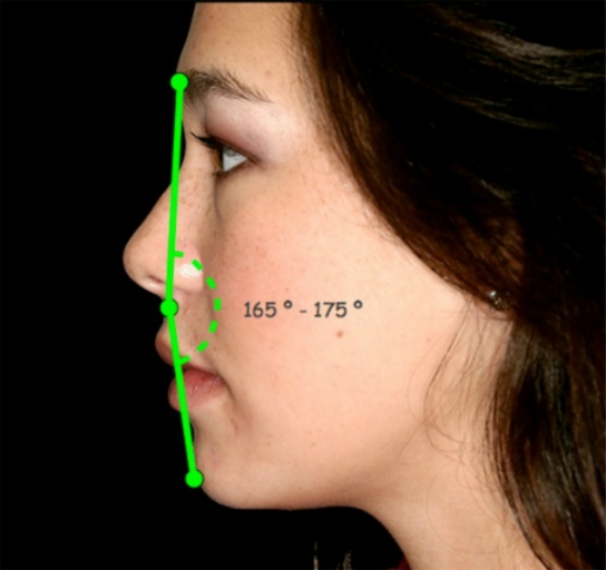 Facial Profile Evaluation: A Clinical Guide for Dentists Profile facial evaluation showing a normal facial profile angle of 165 to 175 degrees using clinical landmarks to assess facial esthetics and treatment planning.