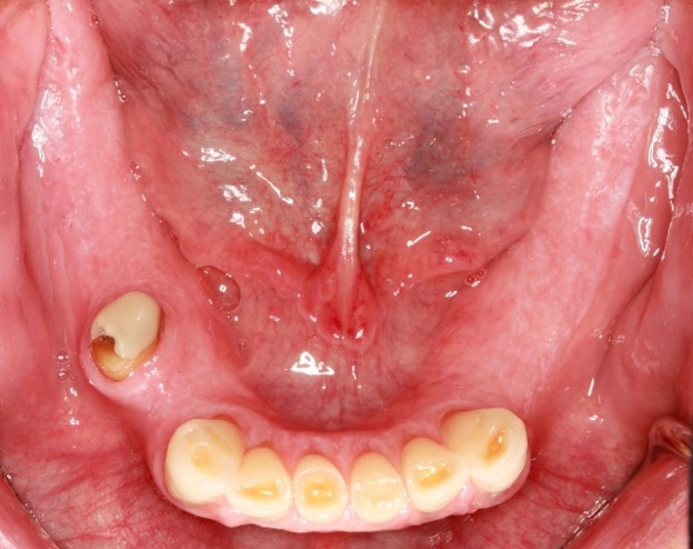efrver Mandibular arch with limited posterior occlusal support, illustrating how to get rid of gag reflex challenges by improving denture stability and functional occlusal contacts.