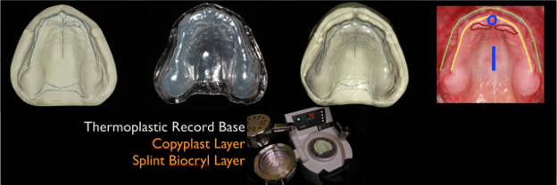 efrver Thermoplastic record base fabricated with Copyplast and Splint Biocryl layers to help patients learn how to get rid of gag reflex sensitivity through progressive desensitization and denture adaptation.