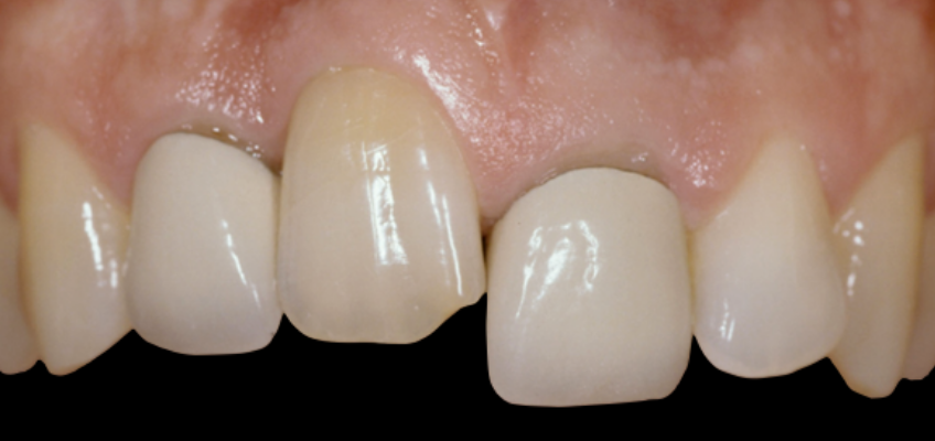 Anterior dental restoration adjacent to an ankylosed tooth showing gingival margin discrepancy and esthetic challenges.