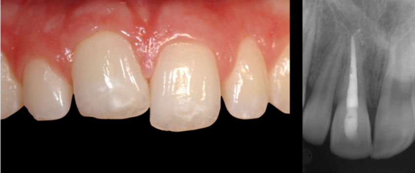 Ankylosed tooth #8 following traumatic avulsion and delayed reimplantation, showing an apically positioned gingival margin and incisal edge compared with adjacent anterior teeth.