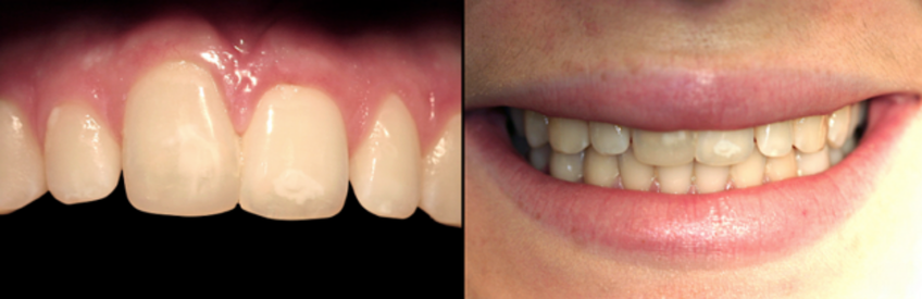 Ankylosed tooth restored with composite resin to lengthen the incisal edge and improve esthetics while delaying extraction and implant treatment.