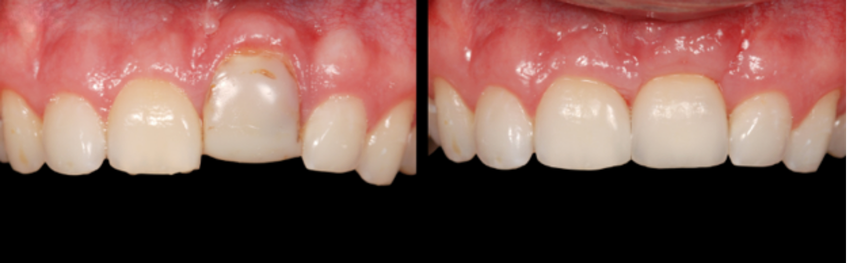 Extraction and site development for an ankylosed tooth showing soft tissue augmentation and restoration of anterior esthetics.