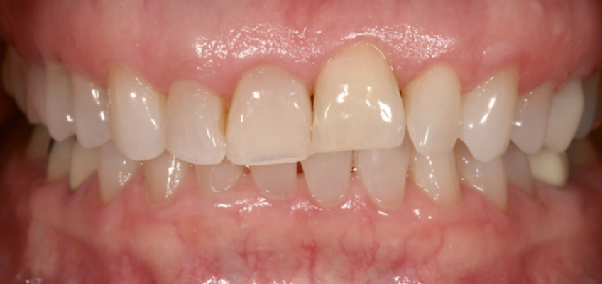Ankylosed tooth #9 demonstrating infraocclusion, altered gingival margin position, and incisal edge discrepancy compared with adjacent anterior teeth.