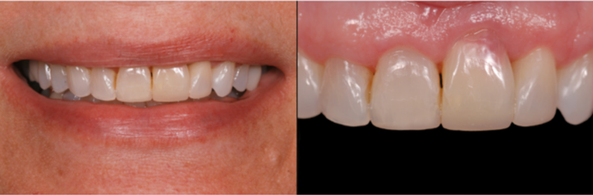 Ankylosed tooth #9 restored with composite resin, showing stable esthetic results and gingival harmony approximately 10 years before extraction became necessary due to progressive root resorption.