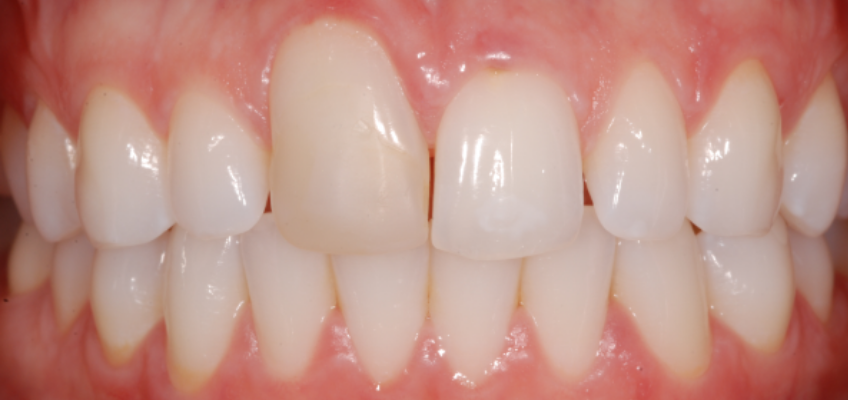 Ankylosed tooth maintained for an additional 10 years with acceptable esthetics and function before extraction became necessary.