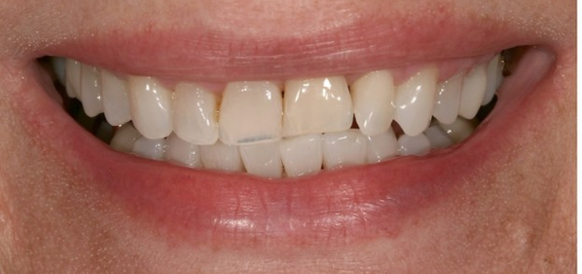 Patient with an ankylosed tooth #9 showing a gingival margin discrepancy that is minimally visible due to a low smile line.