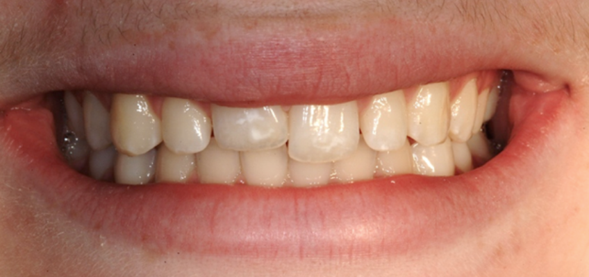 Patient with an ankylosed tooth and a low smile line that conceals the free gingival margin, reducing the visible esthetic impact of gingival asymmetry