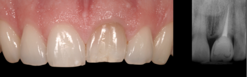 Ankylosed tooth #9 with a level gingival margin and periapical radiograph showing a previously treated maxillary central incisor that became ankylosed after growth completion.