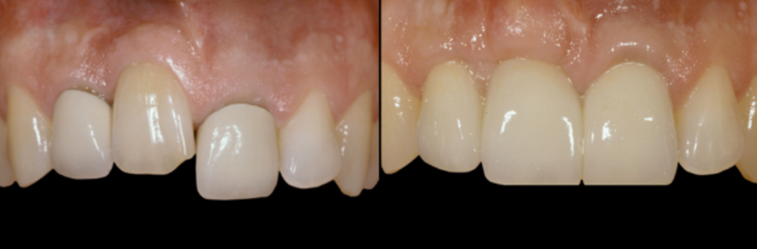 Final restoration following extraction of an ankylosed tooth and tissue augmentation to restore anterior esthetics and gingival symmetry.