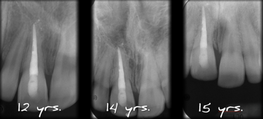 Serial radiographs of an ankylosed tooth demonstrating slow replacement resorption progression over several years following traumatic injury and reimplantation.