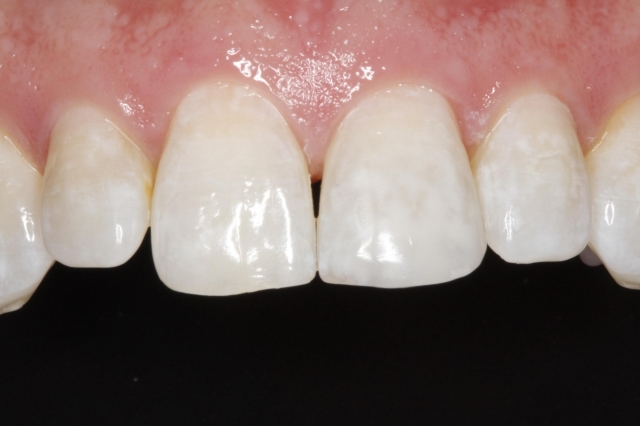 Four Products to Immediately Improve Your Composite Restorations Courtney Lavigne Courtney Lavigne Four Products to Immediately Improve Your Composite Restorations Figure 5