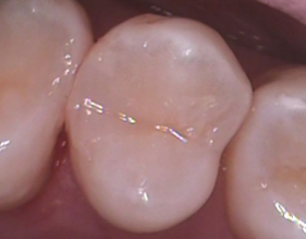 Four Products to Immediately Improve Your Composite Restorations Courtney Lavigne Four Products to Immediately Improve your Composite Restorations figure 7a