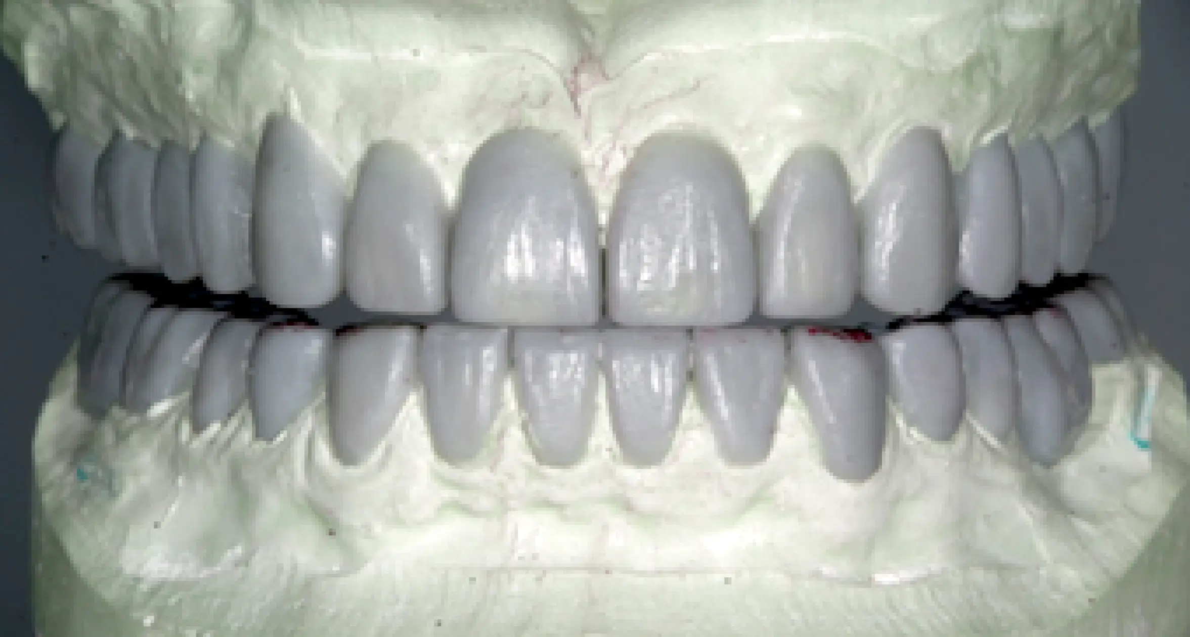 The Pieces of the Puzzle: Technical Steps To Produce a Diagnostic Wax-Up The Pieces of the Puzzle