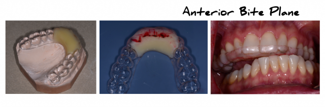 Replacing Triad Provisional Material provisional materials figure 2