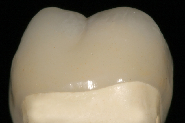 Milled vs. Waxed-And-Pressed Restorations: Which Is Better?