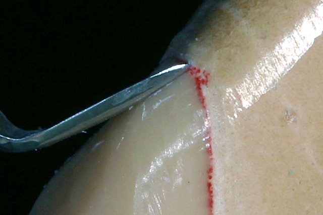 Milled vs. Waxed-And-Pressed Restorations: Which Is Better?