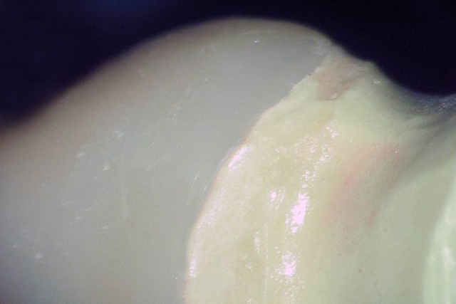 Milled vs. Waxed-And-Pressed Restorations: Which Is Better?