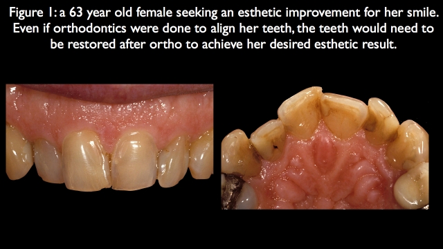 Orthodontic vs. Restorative: Correction of Mal-Aligned Anterior Teeth Frank Spear Orthodontic vs. Restorative Correction of Mal Aligned Anterior Teeth figure 1