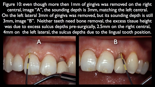 Orthodontic vs. Restorative: Correction of Mal-Aligned Anterior Teeth Frank Spear Orthodontic vs. Restorative Correction of Mal Aligned Anterior Teeth figure 10