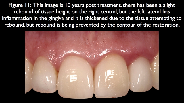 Orthodontic vs. Restorative: Correction of Mal-Aligned Anterior Teeth Frank Spear Orthodontic vs. Restorative Correction of Mal Aligned Anterior Teeth figure 11