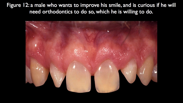 Orthodontic vs. Restorative: Correction of Mal-Aligned Anterior Teeth Frank Spear Orthodontic vs. Restorative Correction of Mal Aligned Anterior Teeth figure 12