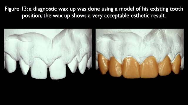 Orthodontic vs. Restorative: Correction of Mal-Aligned Anterior Teeth Frank Spear Orthodontic vs. Restorative Correction of Mal Aligned Anterior Teeth figure 13