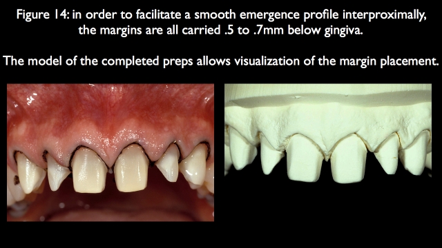 Orthodontic vs. Restorative: Correction of Mal-Aligned Anterior Teeth Frank Spear Orthodontic vs. Restorative Correction of Mal Aligned Anterior Teeth figure 14